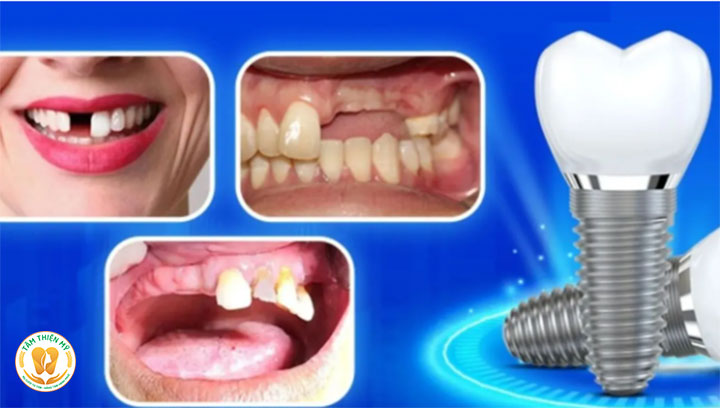 Cấy ghép Implant cá nhân hóa và Implant truyền thống