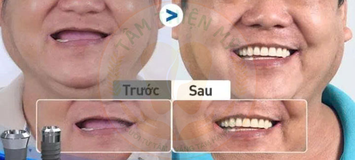 Kỹ thuật cấy ghép răng Implant tại Tâm Thiện Mỹ có gì HOT? 4 mất thẩm mỹ