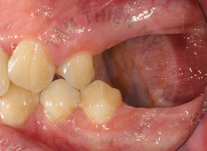 Kỹ thuật cấy ghép răng Implant tại Tâm Thiện Mỹ có gì HOT? 2 cấy ghép implant giúp ngăn chặn tiêu xương hàm