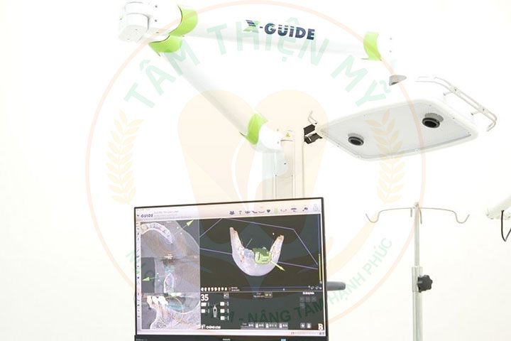Máy CT Cone Beam 3D - Bước đầu quyết định 1 ca Implant thành công 12 Nha khoa Tâm Thiện Mỹ ứng dụng máy CT Cone Beam 3D trong trồng răng Implant