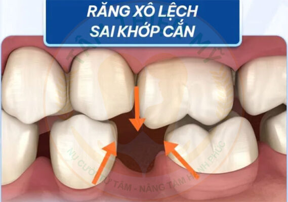 Có nên trồng răng Implant cho trẻ em? Giải pháp cho trẻ em bị mất răng 3 trồng răng Implant cho trẻ em