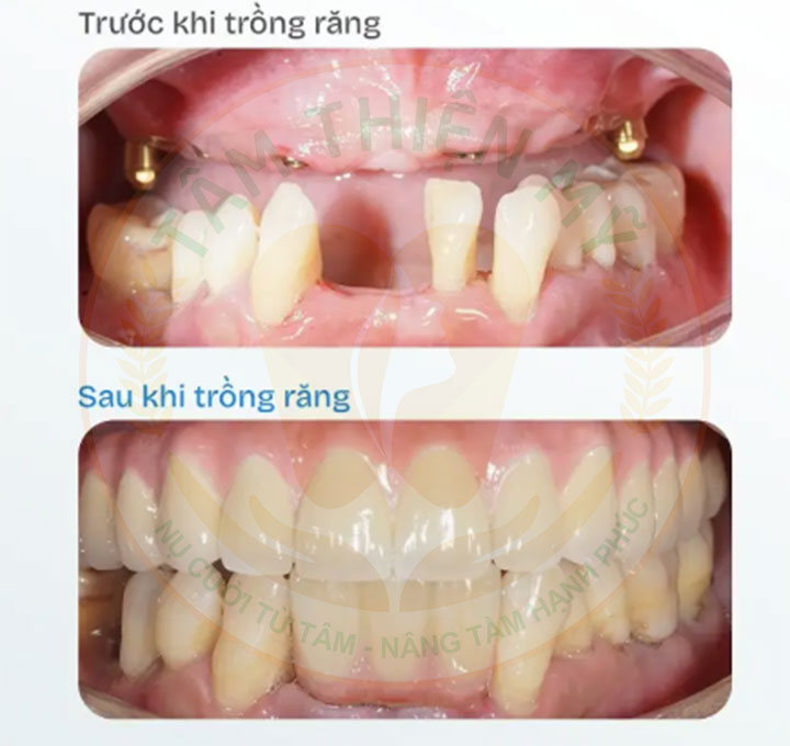 trồng implant cho người mất răng lâu năm