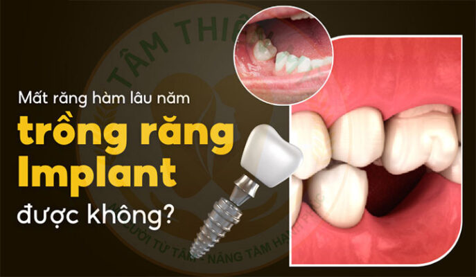 trong implant cho nguoi mat rang lau nam