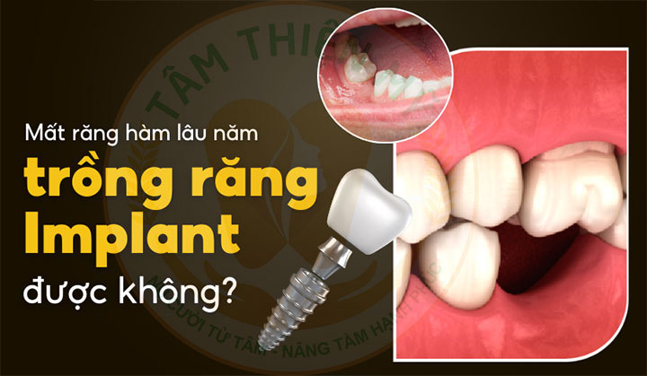 trong implant cho nguoi mat rang lau nam