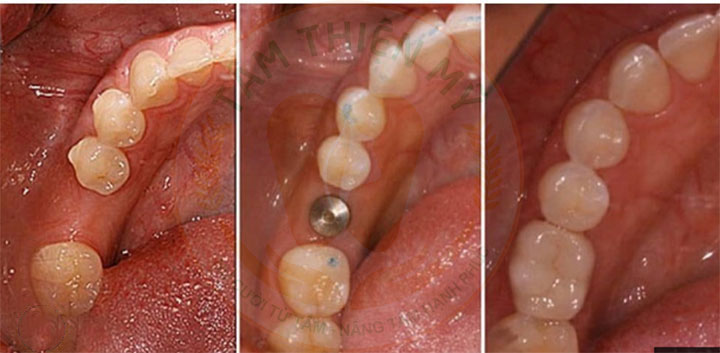 Trồng răng Implant càng sớm - lợi ích dài lâu 7 trồng răng implant