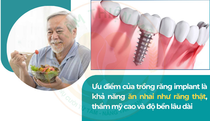 Trồng răng Implant càng sớm - lợi ích dài lâu 6 Cấy ghép Implant sớm đảm bảo chức năng ăn nhai