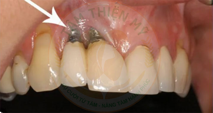 Implant xương bướm - phục hình không ghép xương, nâng xoang 6 trụ implant không tích hợp