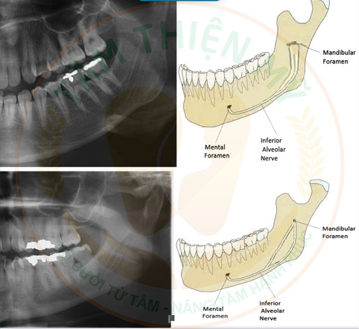 Máy CT Cone Beam 3D - Bước đầu quyết định 1 ca Implant thành công 10 khảo sát xương hàm