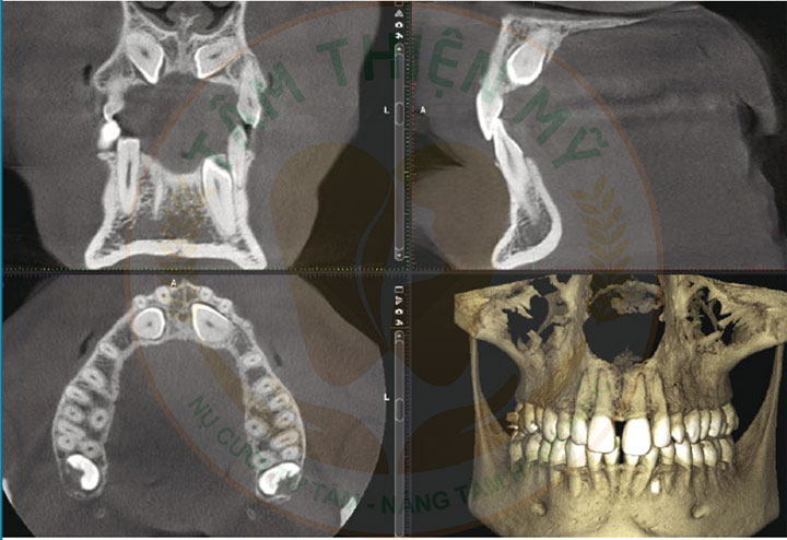 Máy CT Cone Beam 3D - Bước đầu quyết định 1 ca Implant thành công 5 chỉnh nha
