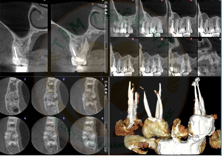 Máy CT Cone Beam 3D - Bước đầu quyết định 1 ca Implant thành công 7 nội nha