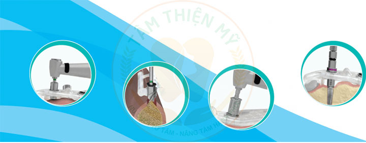 Tầm quan trọng của bộ Kit cấy Implant