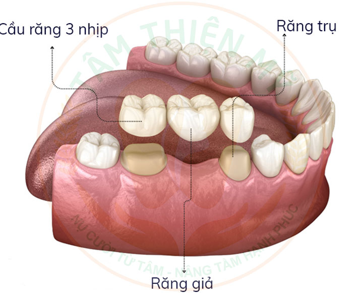 Làm cầu răng sứ có bị tiêu xương không