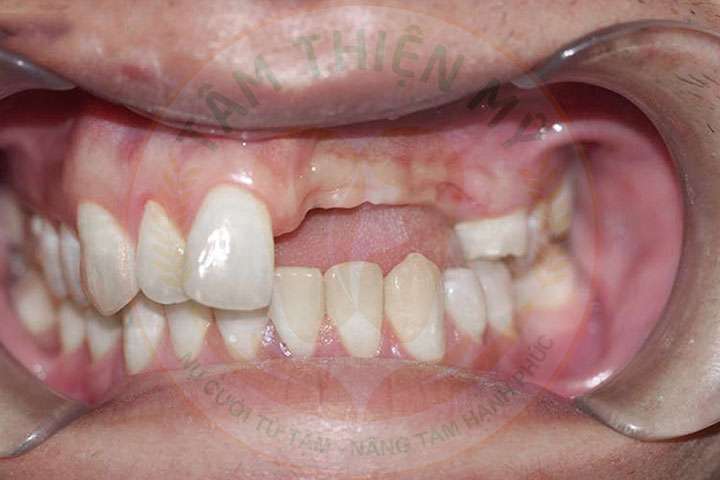 Cấy ghép Implant - phục hình răng cửa bị mất tiên tiến nhất 3 lệch khớp cắn do mất răng