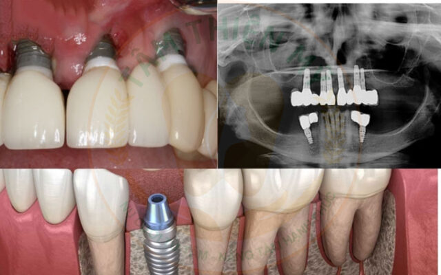 Bị viêm nha chu có trồng răng Implant được không