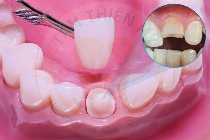 bọc sứ điều trị nứt gãy chân răng
