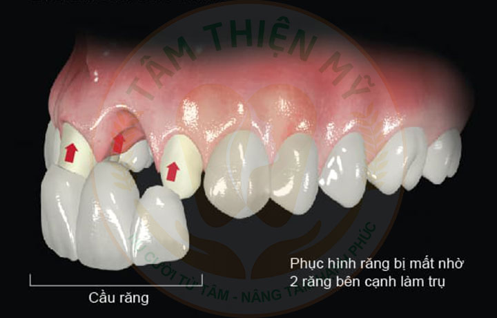 Cấy ghép Implant - phục hình răng cửa bị mất tiên tiến nhất 6 làm cầu răng sứ phục hình răng cửa bị mất
