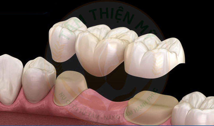 Nguyên nhân và hậu quả khi mất răng số 5- Phục hình răng 5 hiệu 7 Phục hình răng 5 bằng cầu răng sứ