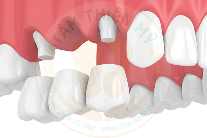 Mất răng số 4 làm cầu răng
