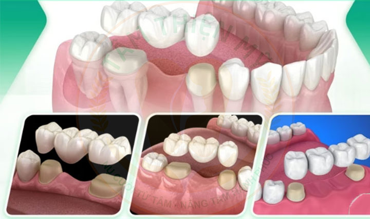 chi phí Trồng răng cấm bao nhiêu tiền