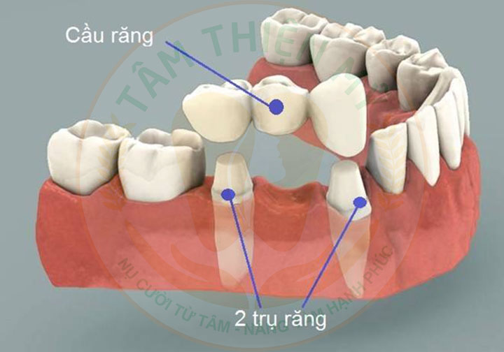 Mầm răng vĩnh viễn là gì? Không có mầm răng vĩnh viễn phải làm sao? 8 Không có mầm răng vĩnh viễn