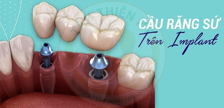 Cầu răng trên Implant - tiết kiệm chi phí cấy ghép Implant 2 Cầu răng trên Implant