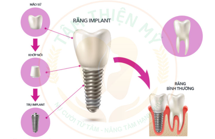 Cầu răng trên Implant - tiết kiệm chi phí cấy ghép Implant 3 cầu răng trên implant
