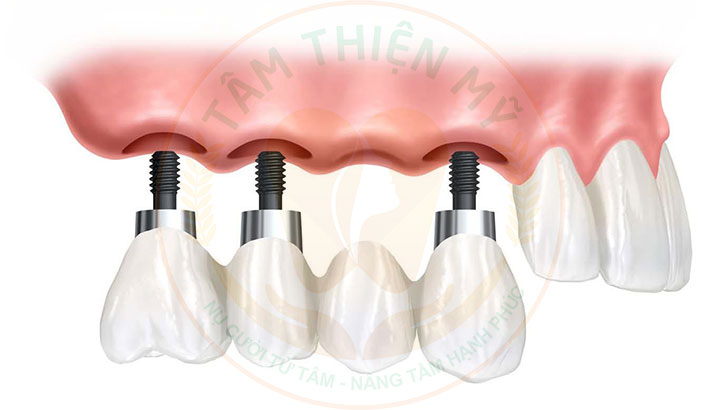 Cầu răng trên Implant - tiết kiệm chi phí cấy ghép Implant 5 cầu răng trên Implant