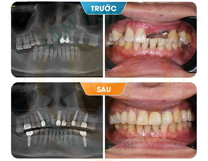 Cầu răng trên Implant - tiết kiệm chi phí cấy ghép Implant 6 cầu răng trên Implant