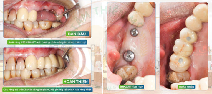 Cầu răng trên Implant - tiết kiệm chi phí cấy ghép Implant 8 cầu răng trên Implant tại Nha khoa Tâm Thiện Mỹ