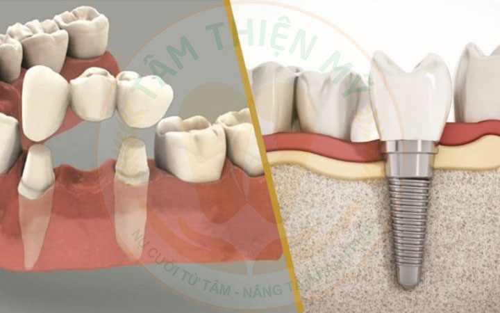 Cầu răng trên Implant - tiết kiệm chi phí cấy ghép Implant 7 cầu răng trên Implant với cầu răng