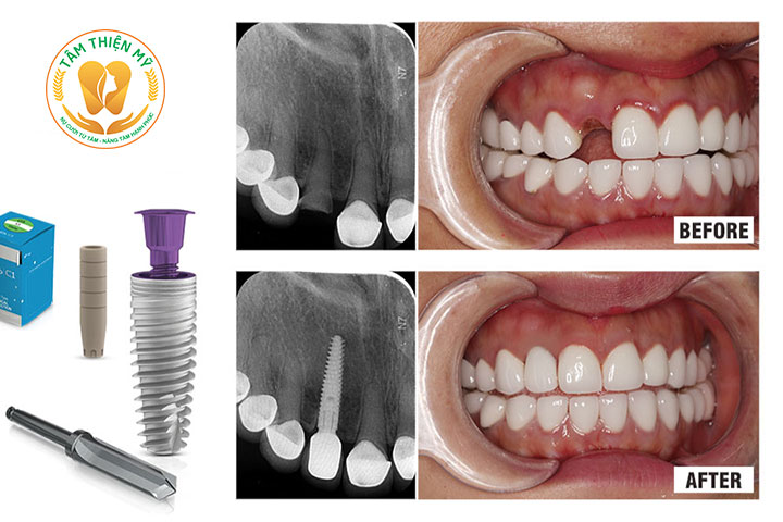Bị tiêu xương sau khi làm cầu răng phải làm sao