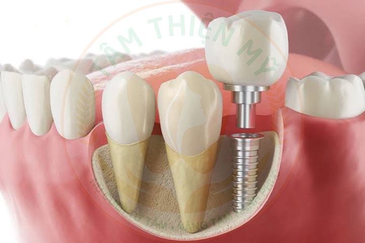 Mất răng 5 bị tiêu xương hàm có cắm được Implant không? 9 cấy ghép implant