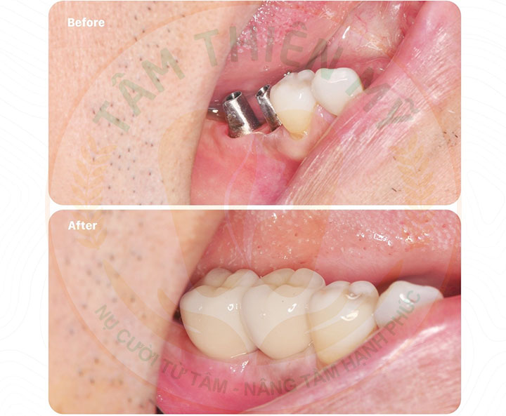 Điều trị viêm nha chu bao lâu thì có thể cấy ghép Implant