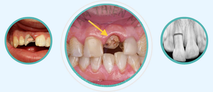các mức độ nứt gãy răng