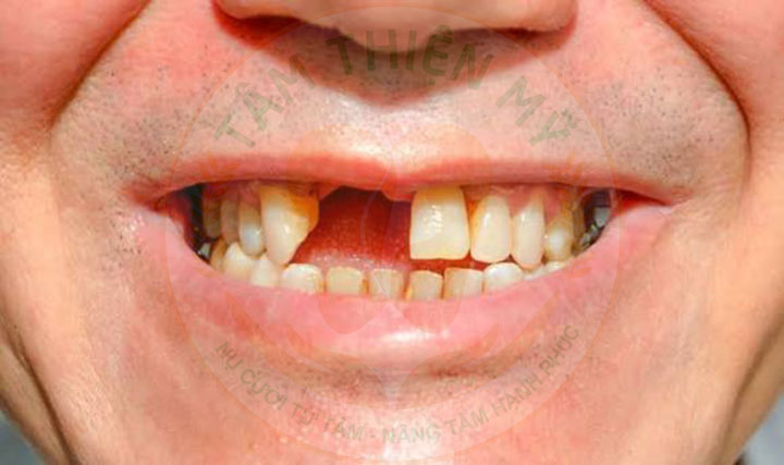gãy chân răng cửa