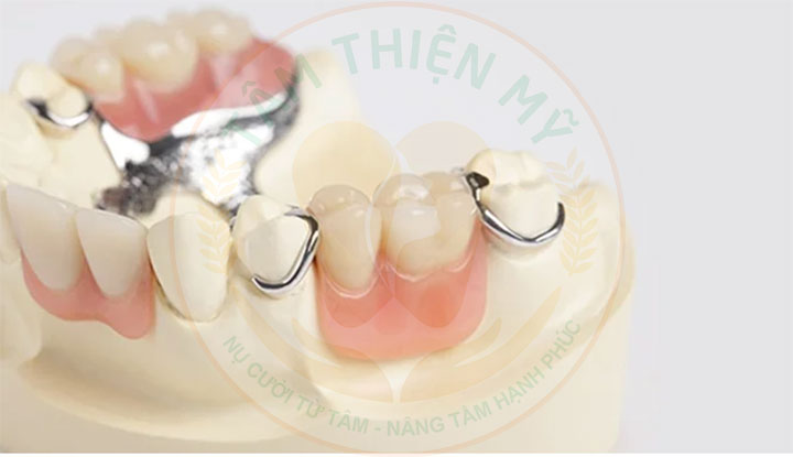 phục hình răng số 6 bị mất bằng hàm giả tháo lắp