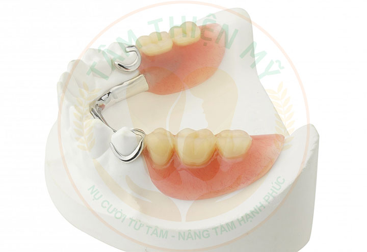 Phục hình răng số 7 hàm trên bằng răng giả tháo lắp