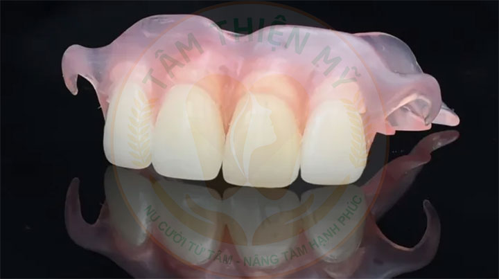 Cấy ghép Implant - phục hình răng cửa bị mất tiên tiến nhất 5 hàm giả tháo lắp phục hình răng cửa bị mất