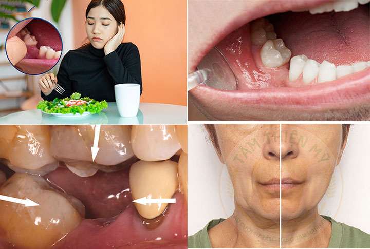 Nguyên nhân và hậu quả khi mất răng số 5- Phục hình răng 5 hiệu 4 Hệ quả của việc mất răng 5 quá lâu