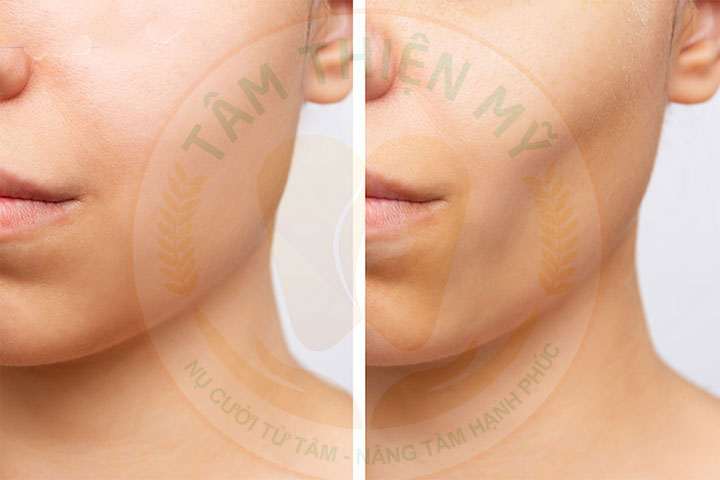 Mất răng 5 bị tiêu xương hàm có cắm được Implant không? 7 Mất răng 5 bị tiêu xương hàm