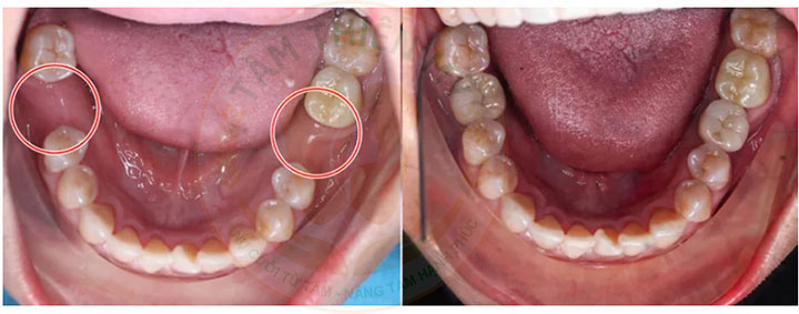 phục hình răng số 6 bằng implant