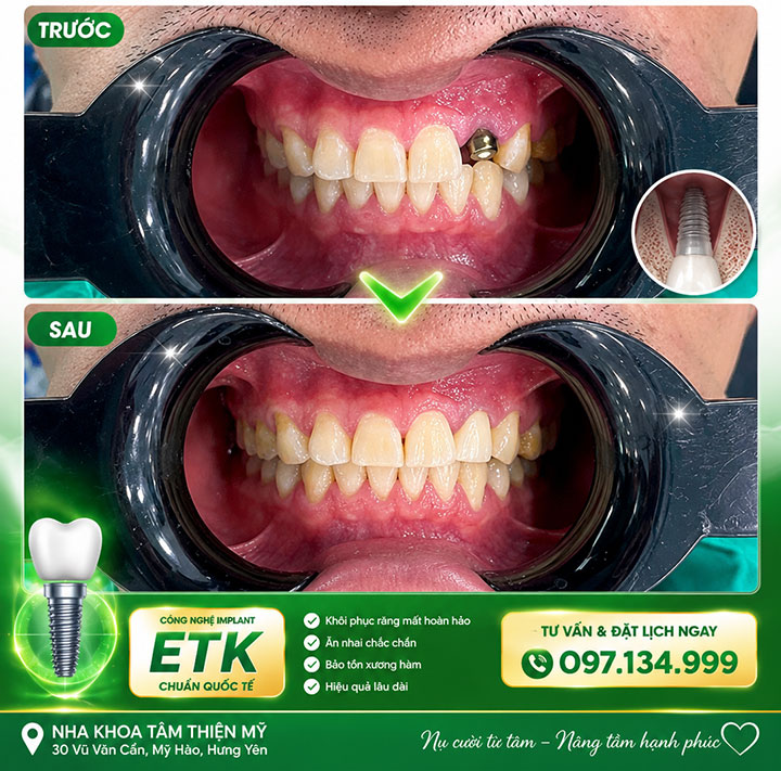 cấy Implant gãy răng cửa