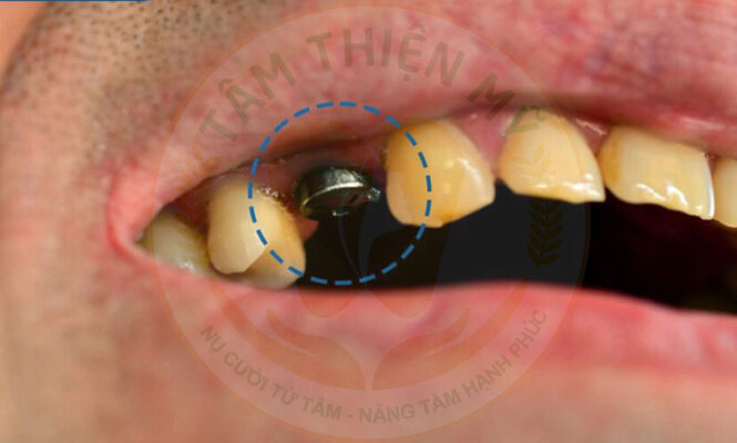 Cấy ghép implant khi mất răng số 4