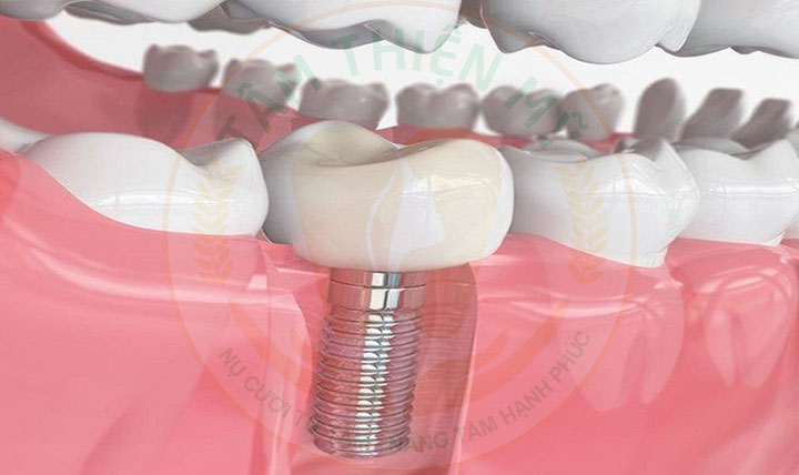 Để mất răng số 7 hàm dưới lâu hậu quả khôn lường 9 Chi phí trồng răng số 7 là bao nhiêu