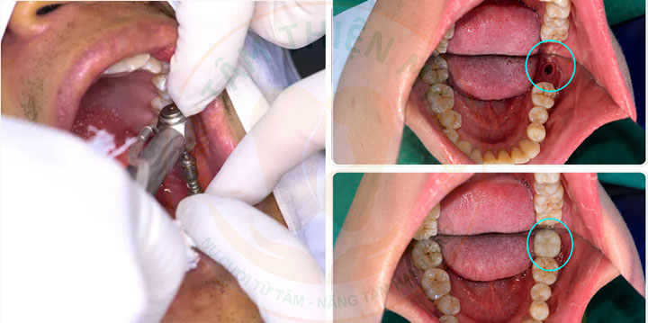 Implant Phục hình Mất răng số 7 hàm dưới bị mất