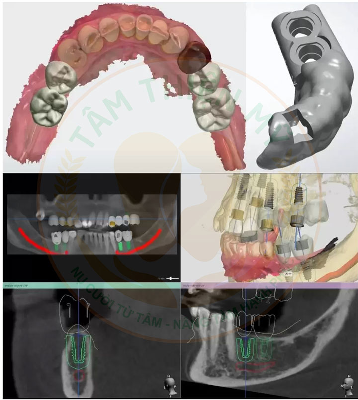 Máng hướng dẫn phẫu thuật Implant
