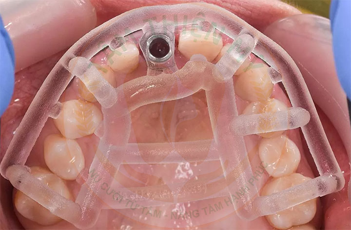 Máng hướng dẫn phẫu thuật Implant