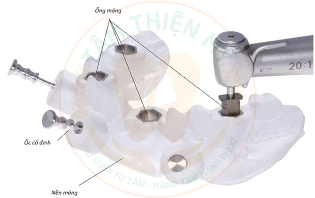 Máng hướng dẫn phẫu thuật Implant