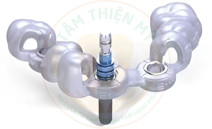 Máng hướng dẫn phẫu thuật Implant