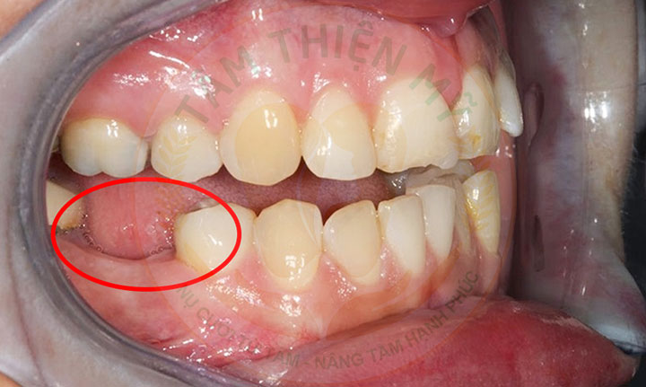 răng số 6 bị mất